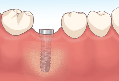 STEP2　インプラント手術